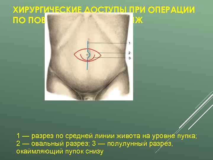 ХИРУРГИЧЕСКИЕ ДОСТУПЫ ПРИ ОПЕРАЦИИ ПО ПОВОДУ ПУПОЧНЫХ ГРЫЖ 1 — разрез по средней линии