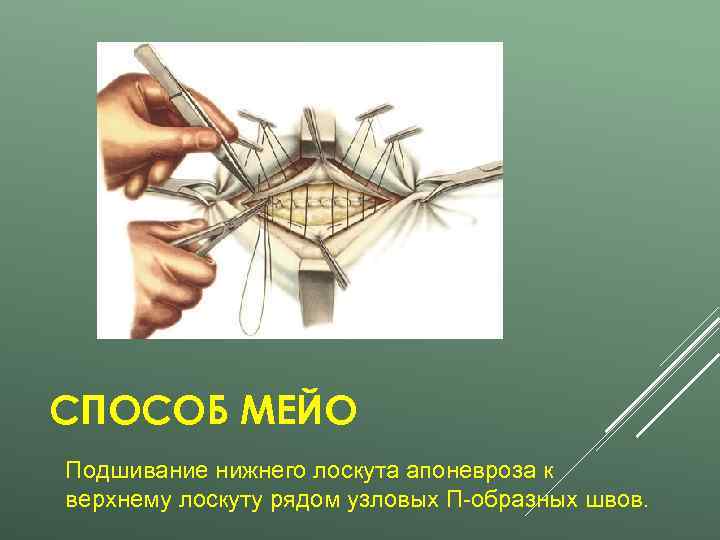 СПОСОБ МЕЙО Подшивание нижнего лоскута апоневроза к верхнему лоскуту рядом узловых П-образных швов. 