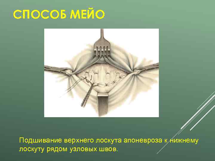 СПОСОБ МЕЙО Подшивание верхнего лоскута апоневроза к нижнему лоскуту рядом узловых швов. 
