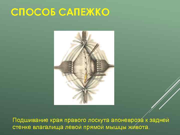 СПОСОБ САПЕЖКО Подшивание края правого лоскута апоневроза к задней стенке влагалища левой прямой мышцы