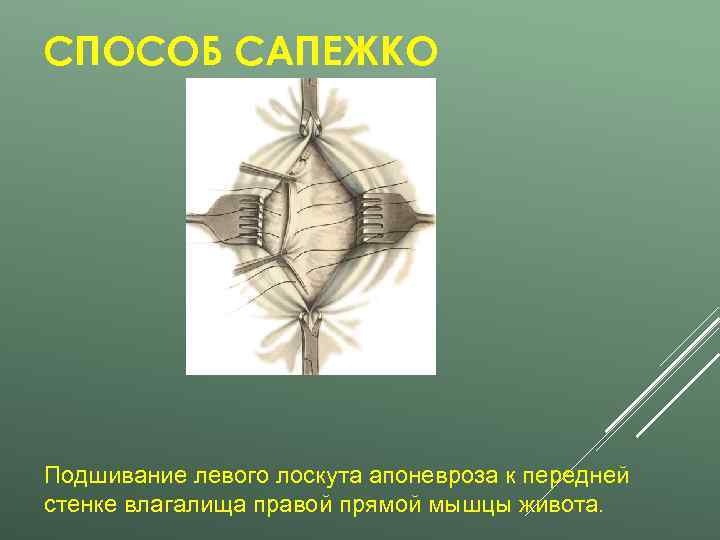 СПОСОБ САПЕЖКО Подшивание левого лоскута апоневроза к передней стенке влагалища правой прямой мышцы живота.