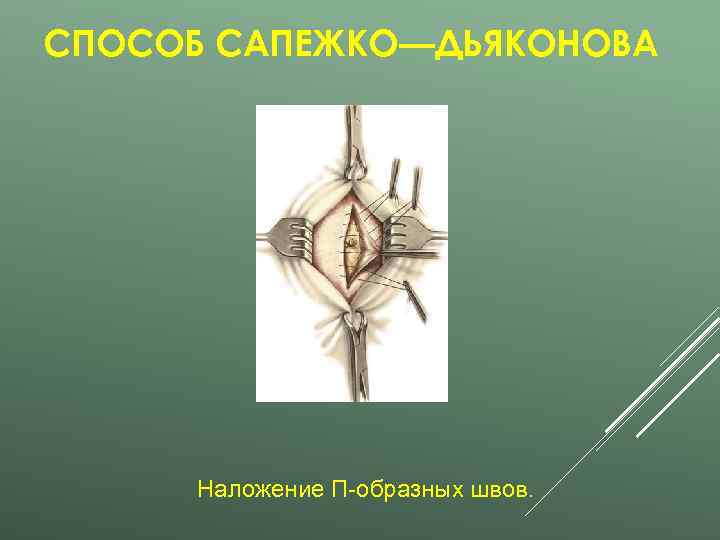 СПОСОБ САПЕЖКО—ДЬЯКОНОВА  Наложение П-образных швов. 