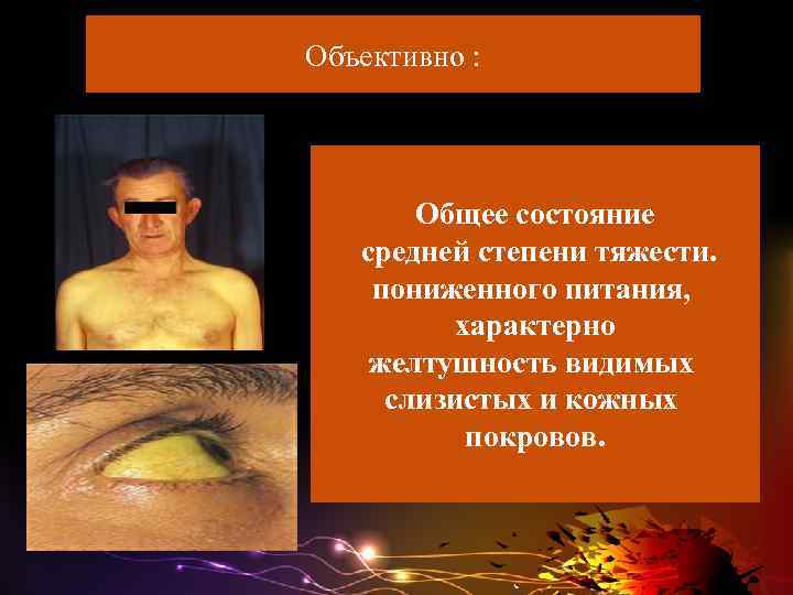 Объективно : Общее состояние средней степени тяжести. пониженного питания, характерно желтушность видимых слизистых и