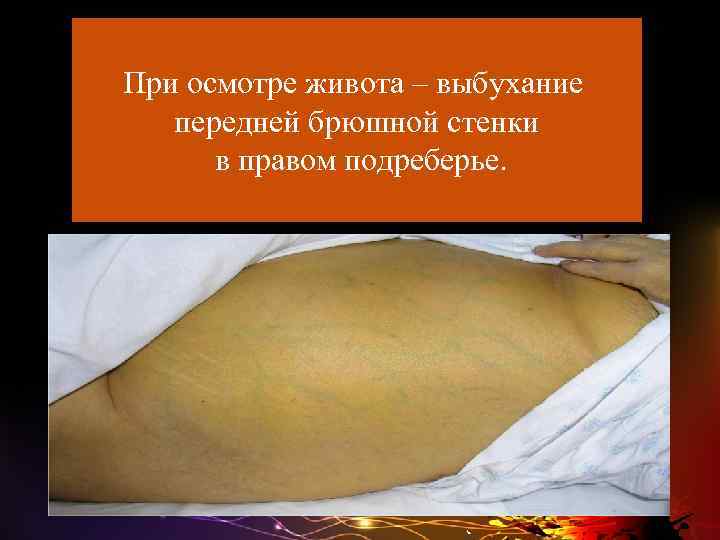 При осмотре живота – выбухание передней брюшной стенки в правом подреберье. 