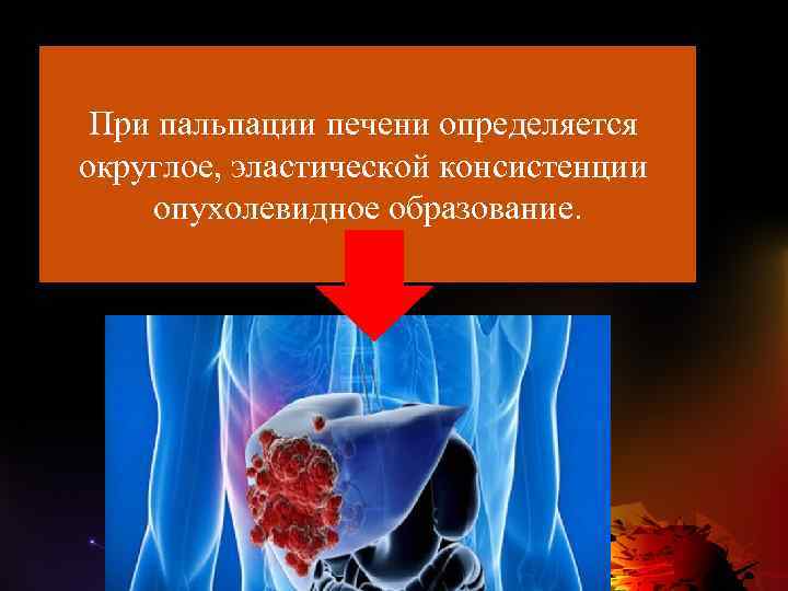 При пальпации печени определяется округлое, эластической консистенции опухолевидное образование. 