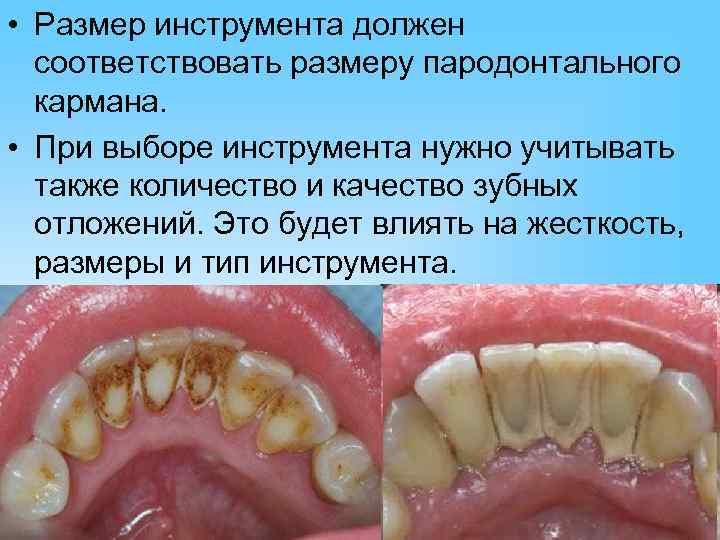 • Размер инструмента должен  соответствовать размеру пародонтального  кармана.  • При
