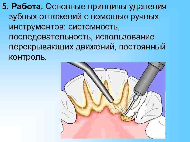 Методы удаления зубных отложений презентация