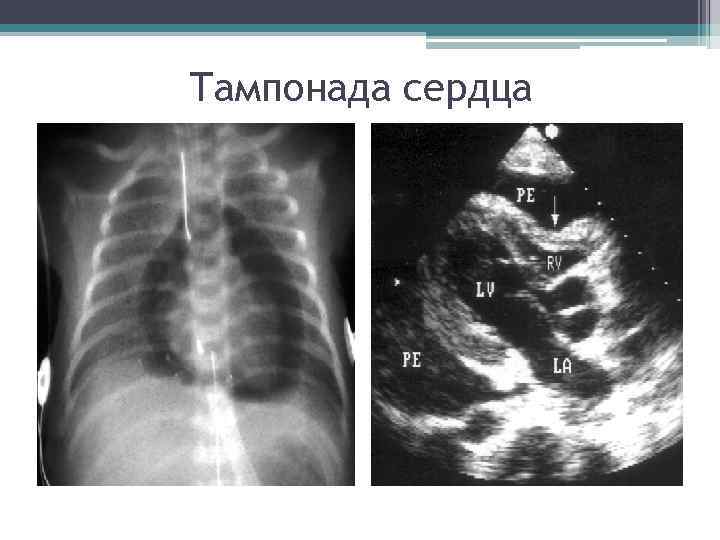 Тампонада сердца Тампонада сердца