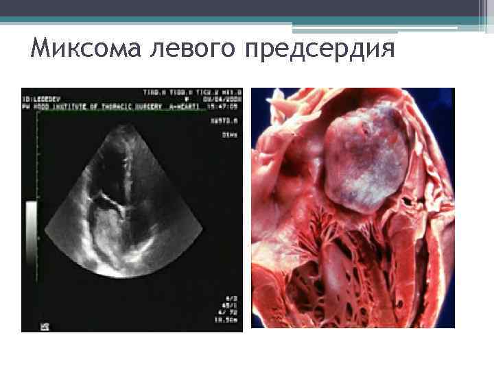 Миксома левого предсердия Миксома левого предсердия