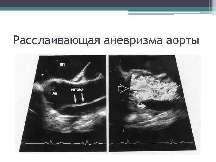 Расслаивающая аневризма аорты Расслаивающая аневризма аорты