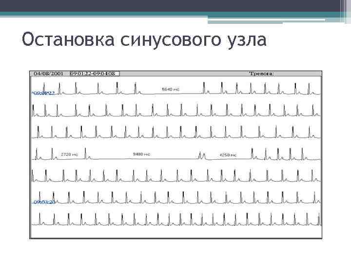 Остановка синусового узла Остановка синусового узла