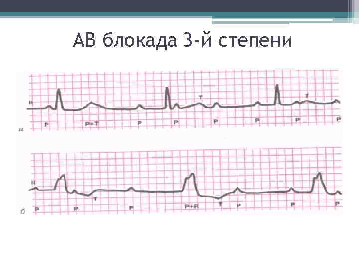 АВ блокада 3 -й степени АВ блокада 3 -й степени