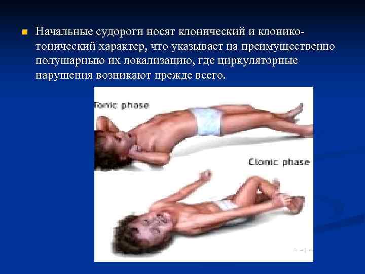 n  Начальные судороги носят клонический и клонико- тонический характер, что указывает на преимущественно