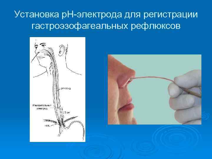 Установка р. Н-электрода для регистрации  гастроэзофагеальных рефлюксов 