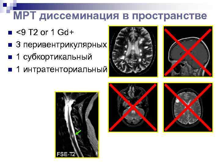   МРТ диссеминация в пространстве n  <9 T 2 or 1 Gd+