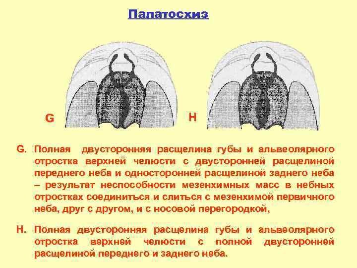 Обозначьте на рисунке виды расщелин