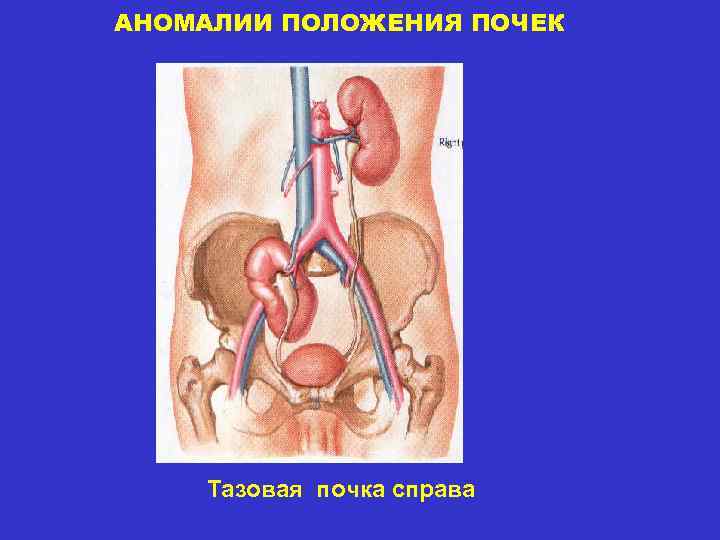 АНОМАЛИИ ПОЛОЖЕНИЯ ПОЧЕК Тазовая почка справа 