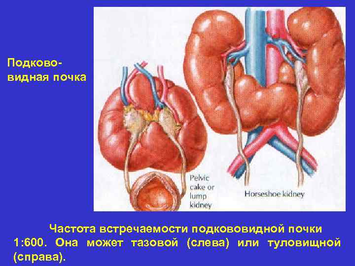 Подкововидная почка Частота встречаемости подкововидной почки 1: 600. Она может тазовой (слева) или туловищной