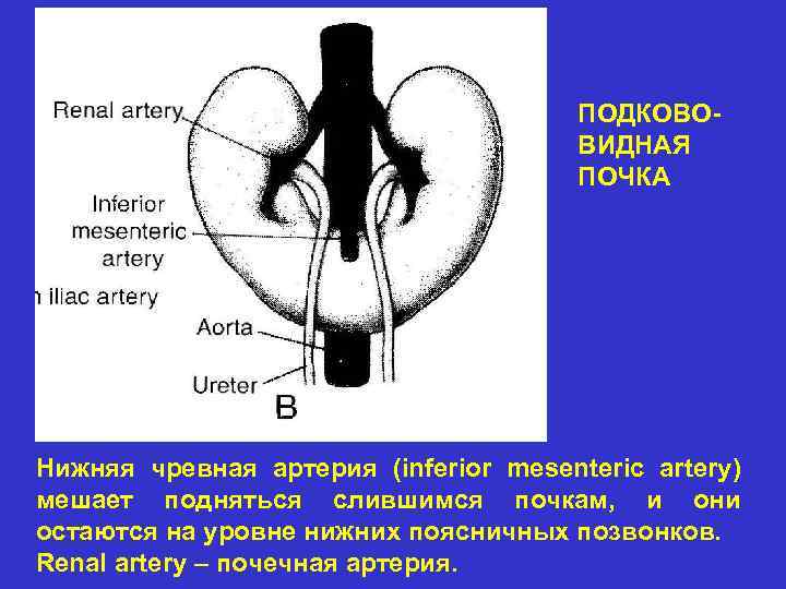 ПОДКОВОВИДНАЯ ПОЧКА Нижняя чревная артерия (inferior mesenteric artery) мешает подняться слившимся почкам, и они