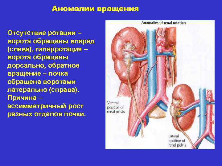 Аномалии вращения Отсутствие ротации – ворота обращены вперед (слева), гиперротация – ворота обращены дорсально,