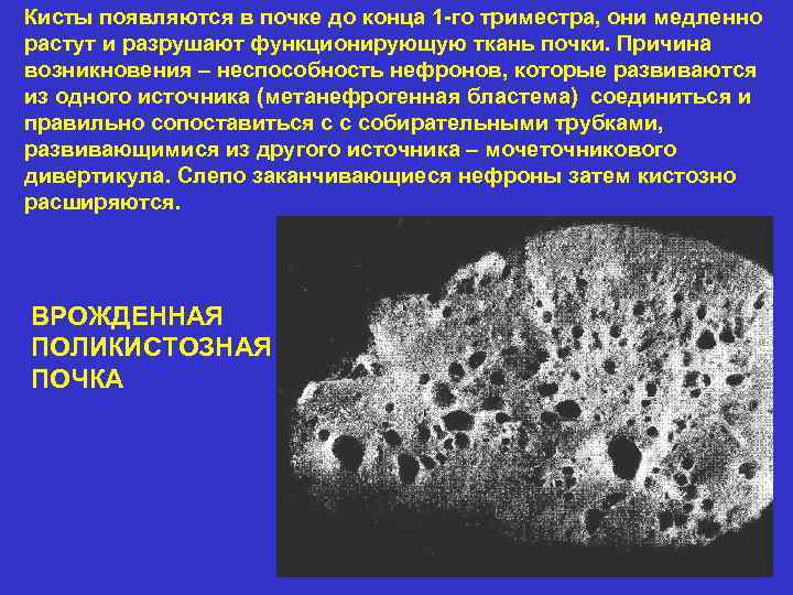 Кисты появляются в почке до конца 1 -го триместра, они медленно растут и разрушают
