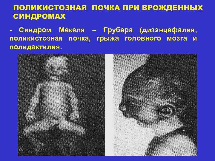 ПОЛИКИСТОЗНАЯ ПОЧКА ПРИ ВРОЖДЕННЫХ СИНДРОМАХ - Синдром Мекеля – Грубера (дизэнцефалия, поликистозная почка, грыжа