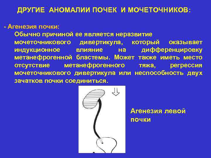 ДРУГИЕ АНОМАЛИИ ПОЧЕК И МОЧЕТОЧНИКОВ: - Агенезия почки: Обычно причиной ее является неразвитие мочеточникового