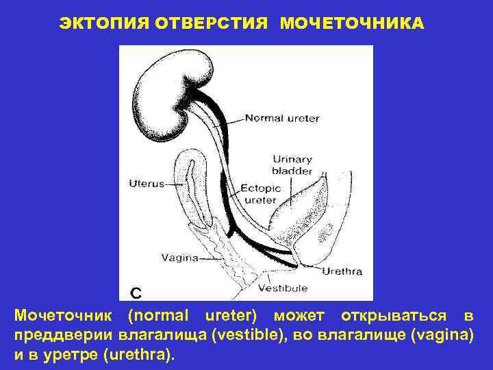 ЭКТОПИЯ ОТВЕРСТИЯ МОЧЕТОЧНИКА Мочеточник (normal ureter) может открываться в преддверии влагалища (vestible), во влагалище