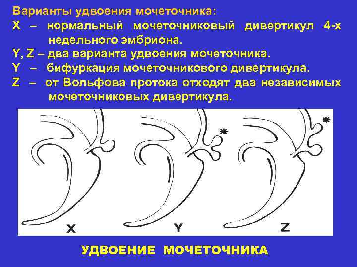 Варианты удвоения мочеточника: X – нормальный мочеточниковый дивертикул 4 -х недельного эмбриона. Y, Z
