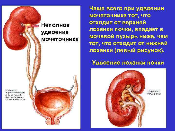 Неполное удвоение мочеточника Чаще всего при удвоении мочеточника тот, что отходит от верхней лоханки