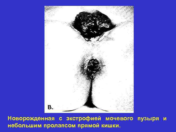 Новорожденная с экстрофией мочевого пузыря и небольшим пролапсом прямой кишки. 