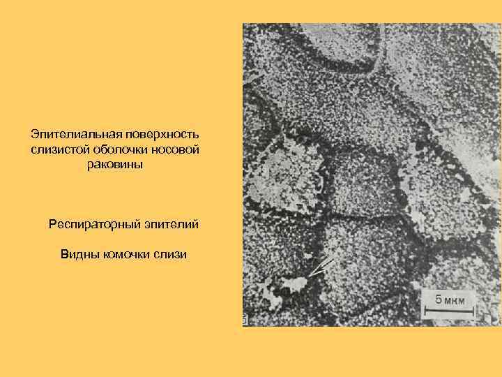 Эпителиальная поверхность слизистой оболочки носовой раковины Респираторный эпителий Видны комочки слизи 
