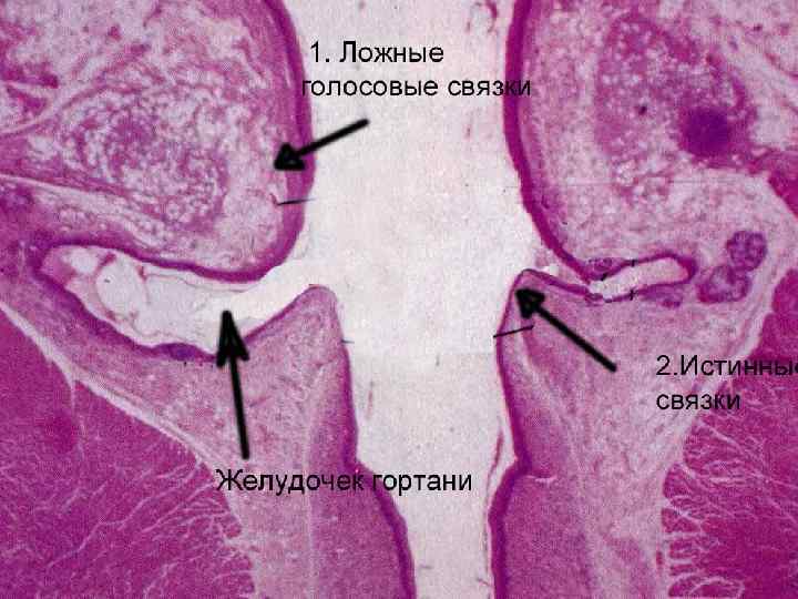 Ложные голосовые связки