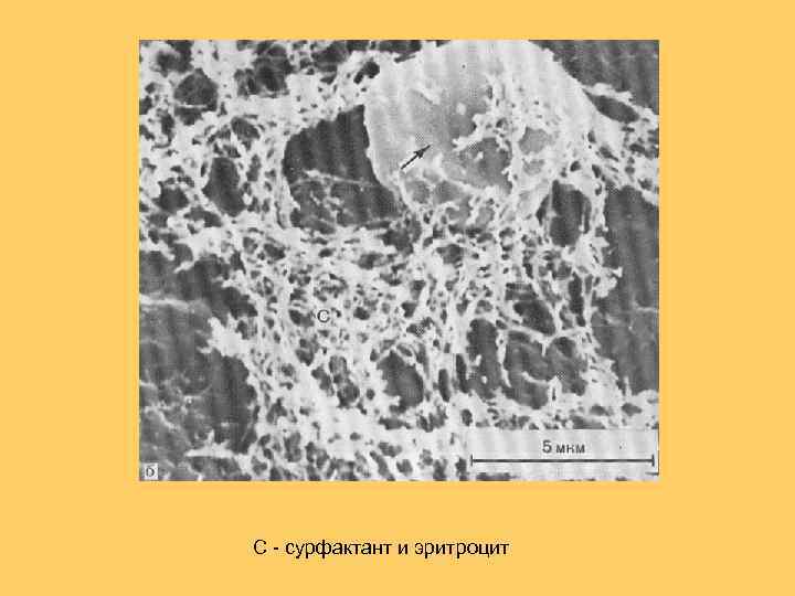 С - сурфактант и эритроцит 