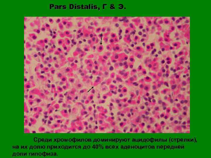 Pars Distalis, Г & Э. Среди хромофилов доминируют ацидофилы (стрелки), на их долю приходится