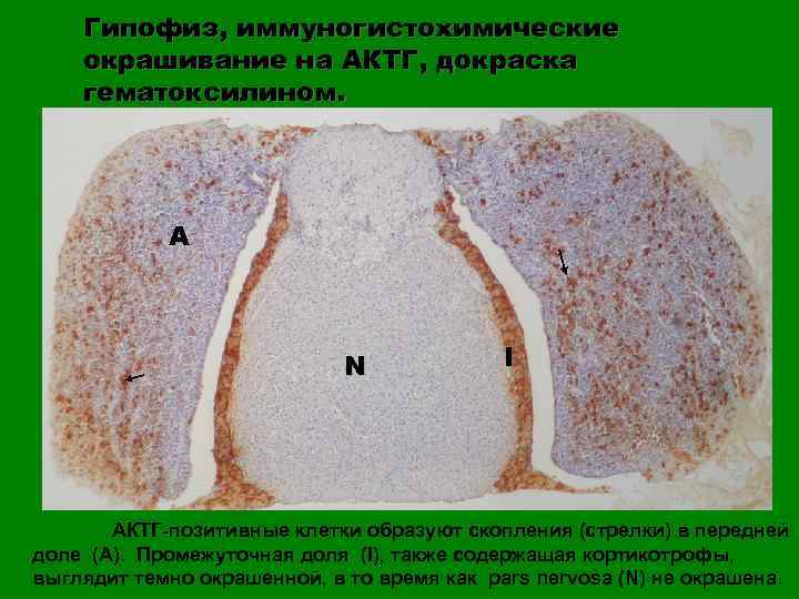 Гипофиз, иммуногистохимические окрашивание на АКТГ, докраска гематоксилином. A N I АКТГ-позитивные клетки образуют скопления