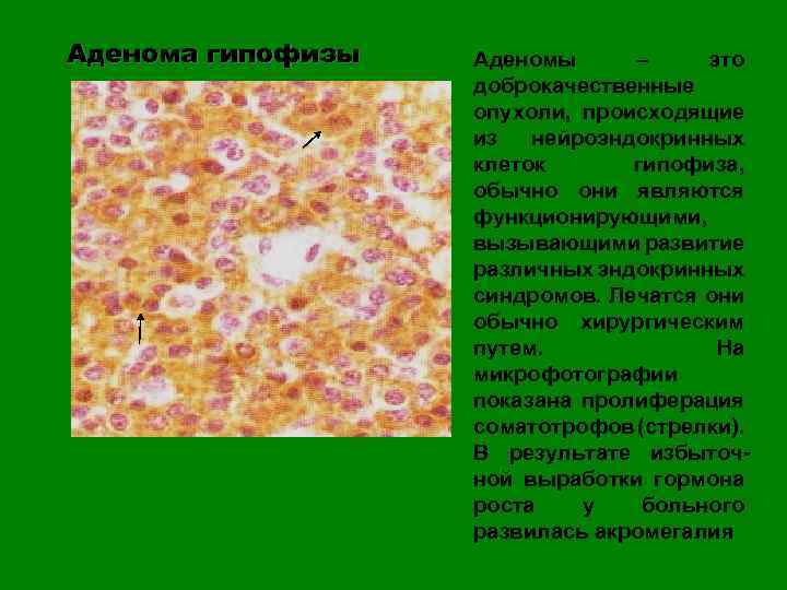 Аденома гипофизы Аденомы – это доброкачественные опухоли, происходящие из нейроэндокринных клеток гипофиза, обычно они