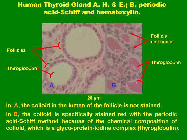 Human Thyroid Gland A. H. & E. ; B. periodic acid-Schiff and hematoxylin. Follicle