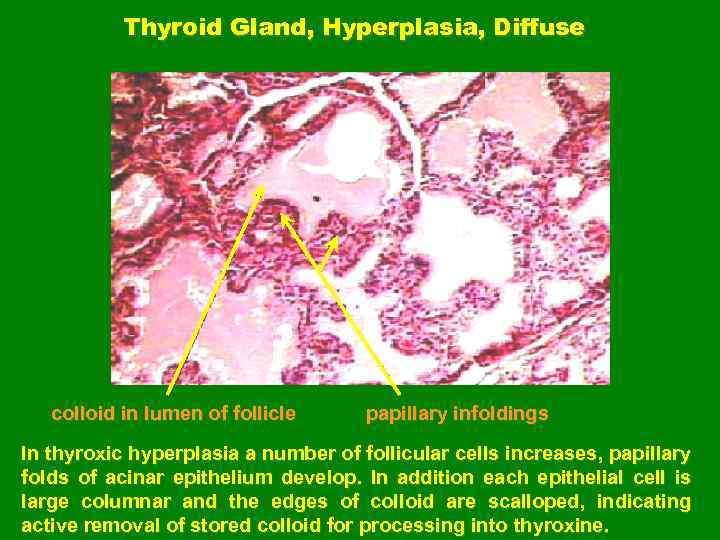 Thyroid Gland, Hyperplasia, Diffuse colloid in lumen of follicle papillary infoldings In thyroxic hyperplasia