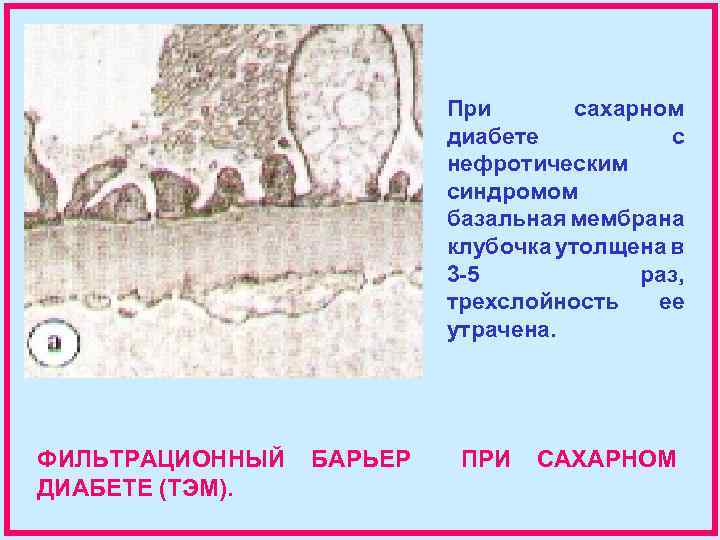 При сахарном диабете с нефротическим синдромом базальная мембрана клубочка утолщена в 3 -5 раз,