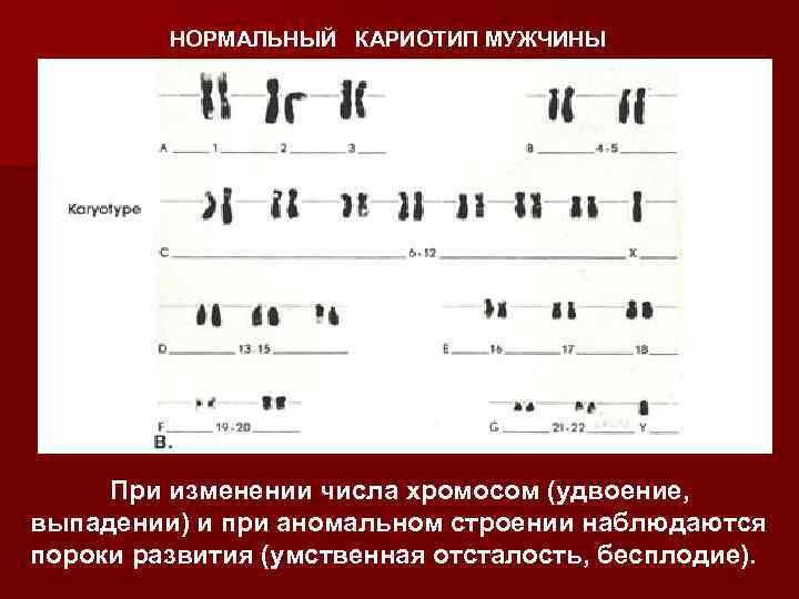 НОРМАЛЬНЫЙ КАРИОТИП МУЖЧИНЫ При изменении числа хромосом (удвоение, выпадении) и при аномальном строении наблюдаются