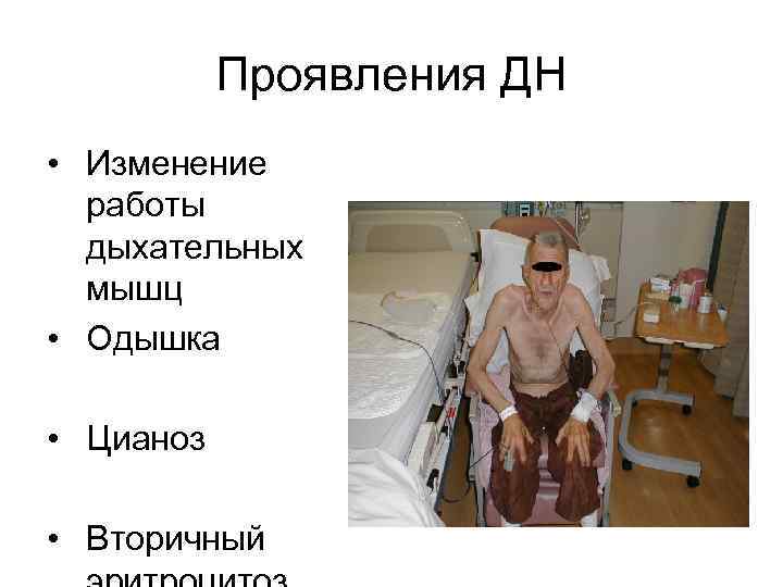 Проявления ДН • Изменение работы дыхательных мышц • Одышка • Цианоз • Вторичный 