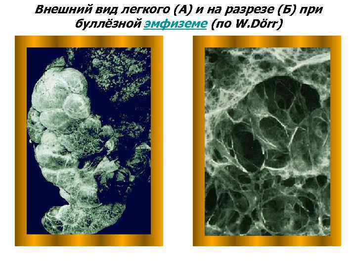 Внешний вид легкого (А) и на разрезе (Б) при буллёзной эмфиземе (по W. Dörr)