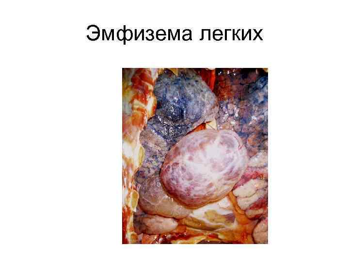 Эмфизема легких 