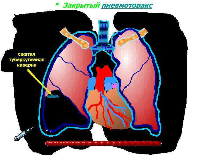 * Закрытый пневмоторакс сжатая туберкулёзная каверна, которую каверна необходимо сжать воздух 