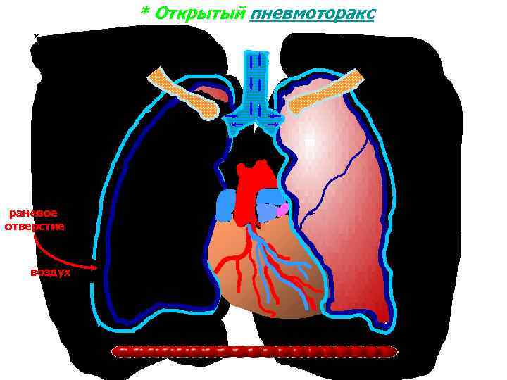 * Открытый пневмоторакс раневое отверстие воздух 