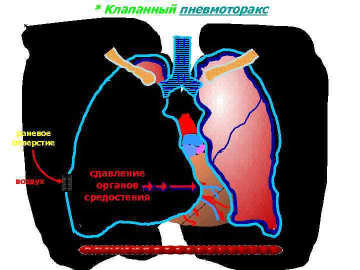* Клапанный пневмоторакс раневое отверстие воздух сдавление органов средостения 