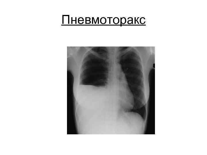 Пневмоторакс 