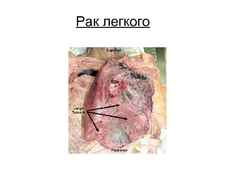 Рак легкого 