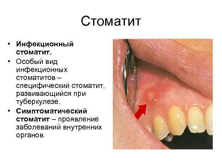 Стоматит • Инфекционный стоматит. • Особый вид инфекционных стоматитов – специфический стоматит, развивающийся при